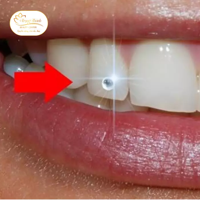 Cách bảo quản và duy trì đá răng thẩm mỹ